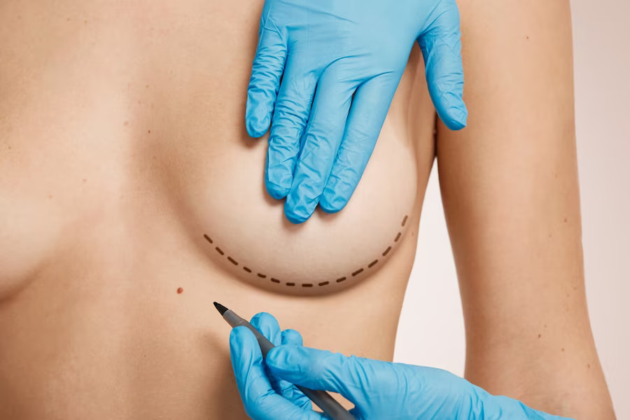 Breast Augmentation in Malaysia