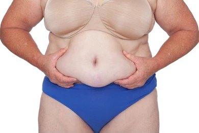 Belt Lipectomy