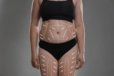 Mini Tummy Tuck