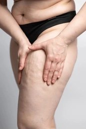 Thigh Liposuction