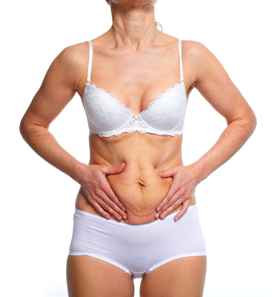 Tummy Tuck Candidate